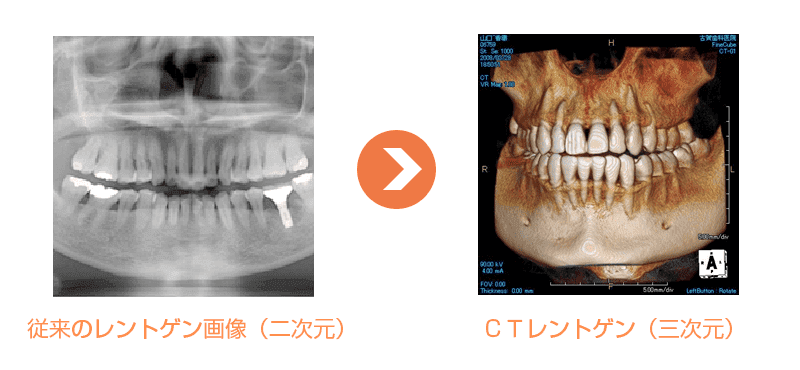 ＣＴレントゲン