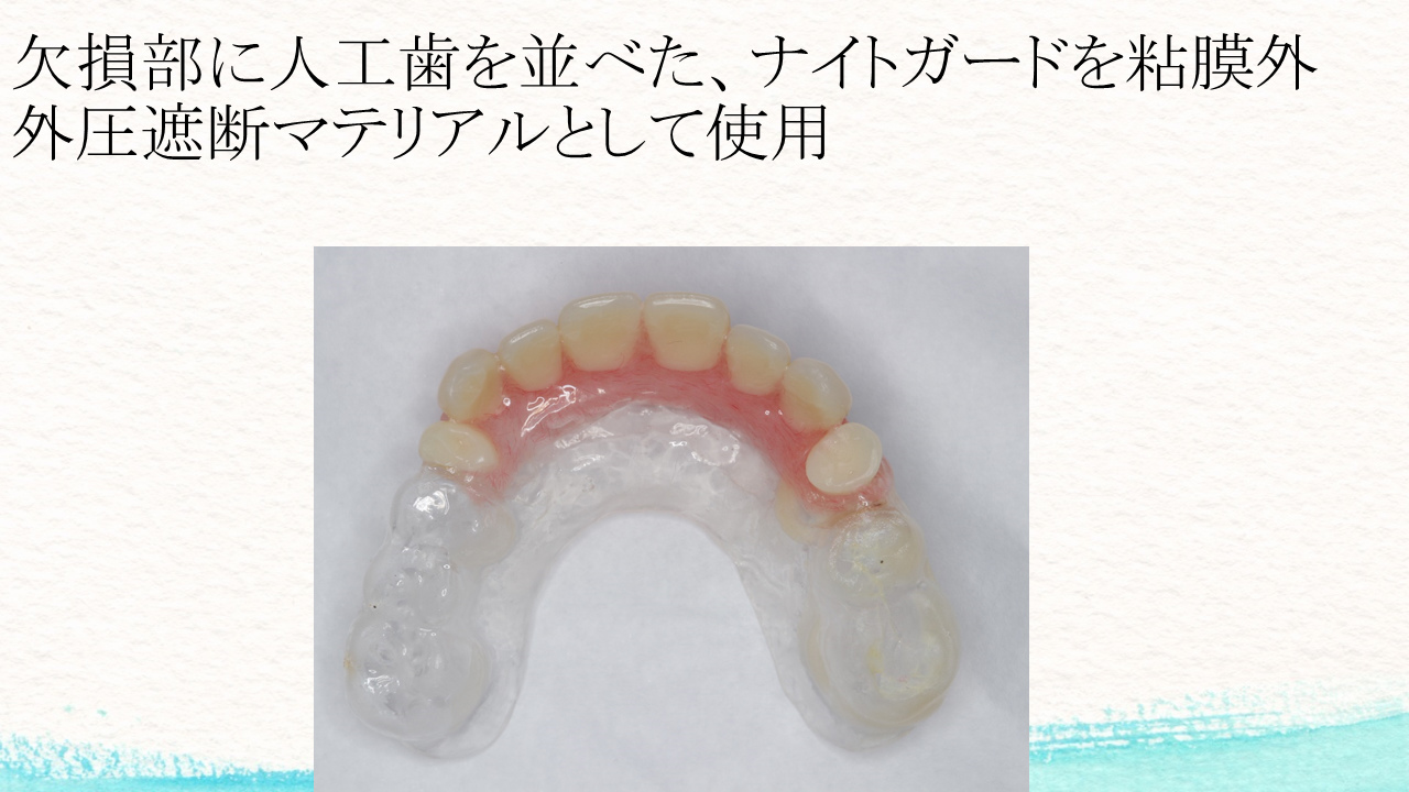 外圧遮断とGBR法を併用し上顎前歯部にインプラントを行った1症例