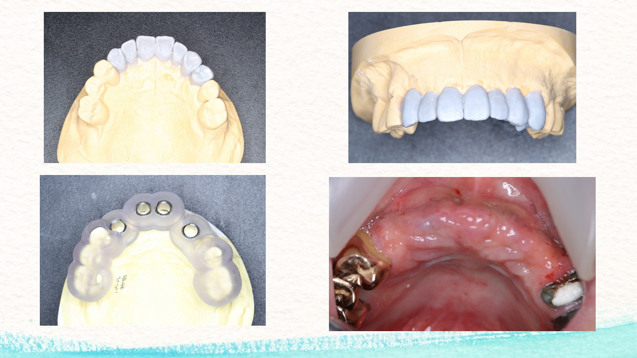 外圧遮断とGBR法を併用し上顎前歯部にインプラントを行った1症例