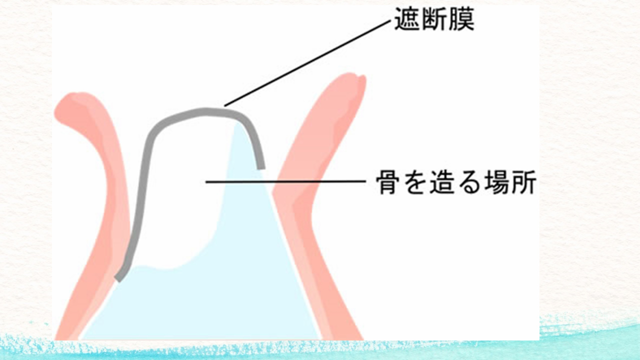 外圧遮断とGBR法を併用し上顎前歯部にインプラントを行った1症例