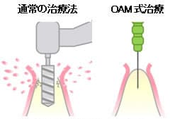 OAMインプラント方式