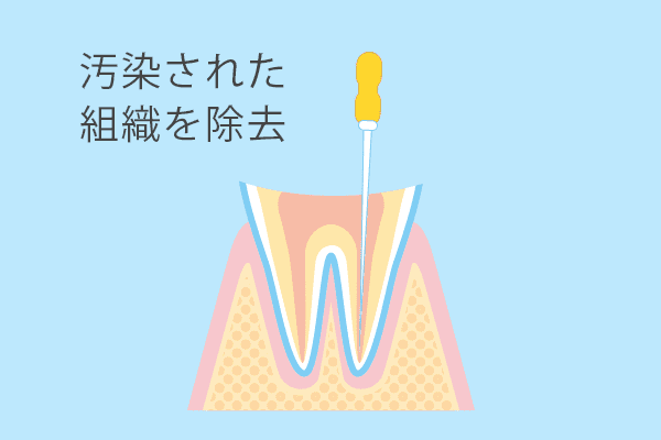 根の治療を丁寧にすることが再発防止につながります