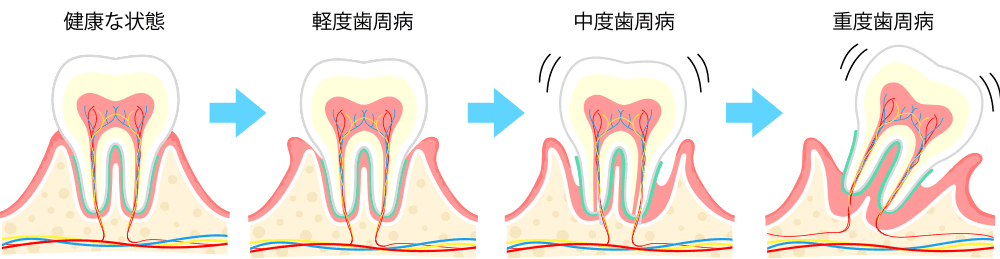 歯周病は生活習慣病