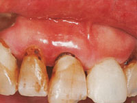 保険の前歯の特徴