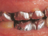 保険の奥歯の特徴