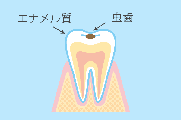 小さい虫歯治療